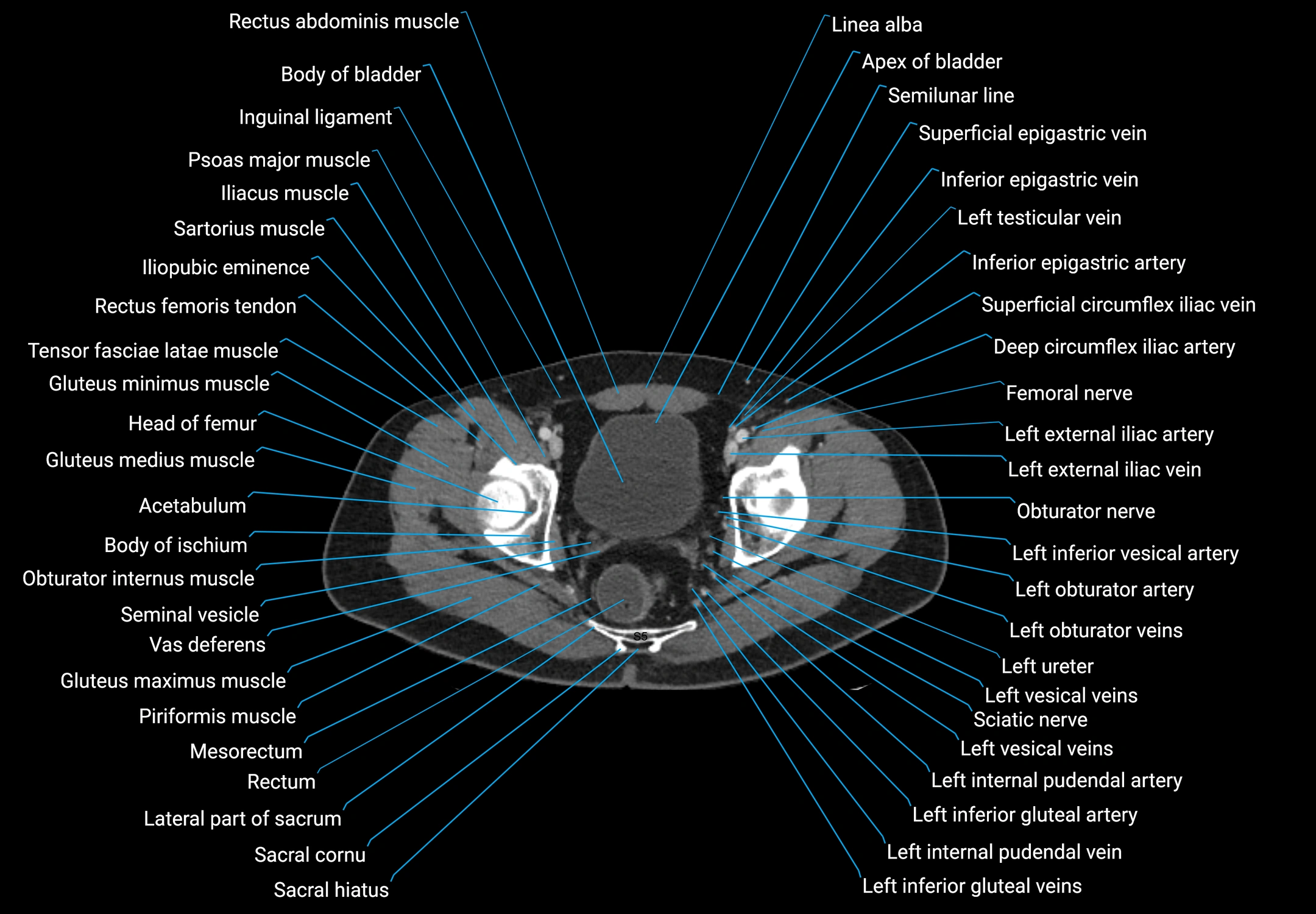 CT male pelvis axial cross sectional anatomy labelled radiology image -00179.webp